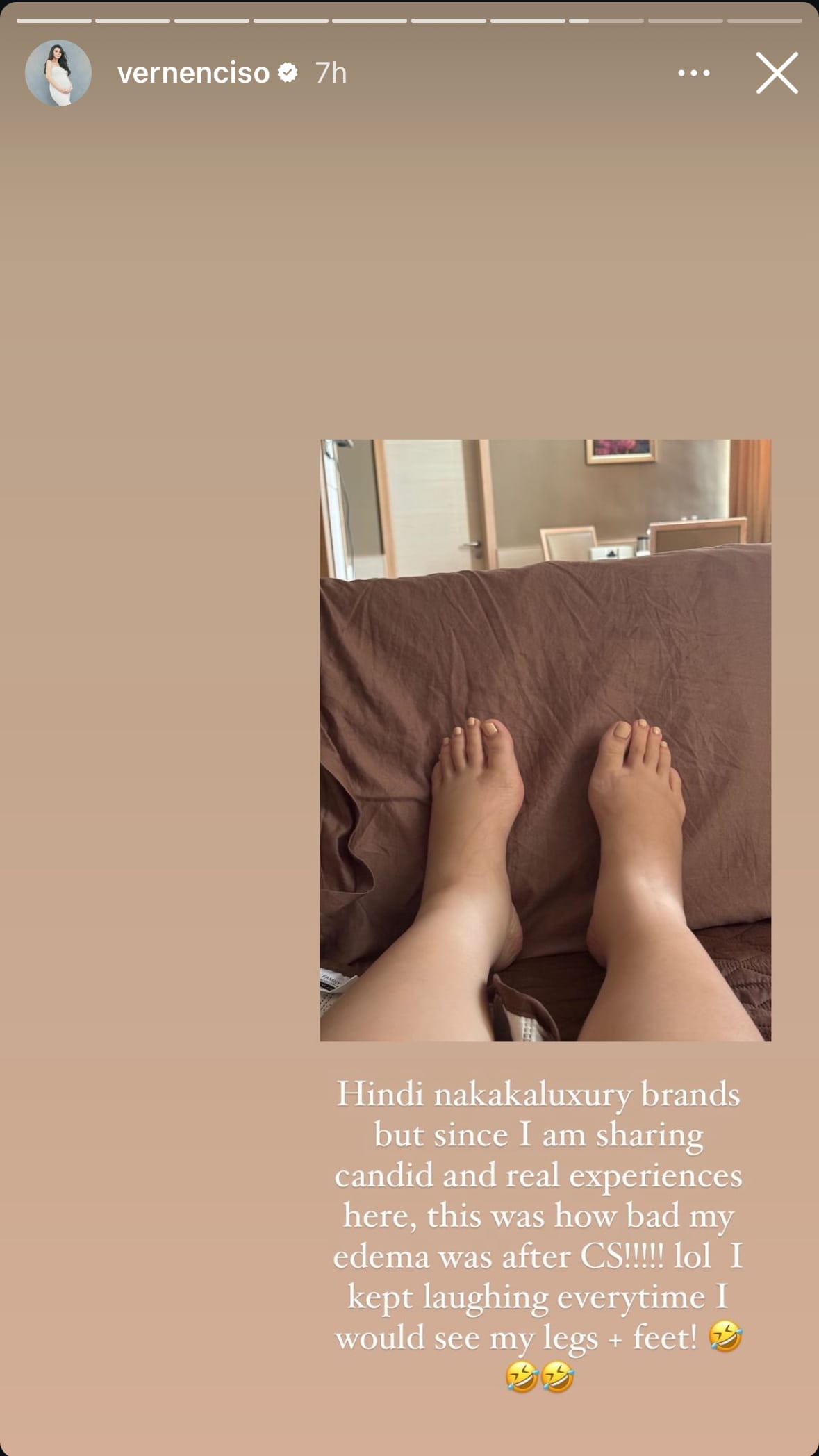 Vern's swollen feet