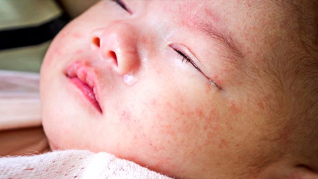 How to Prevent Measles: Give First Dose of Vaccine at 6 Months