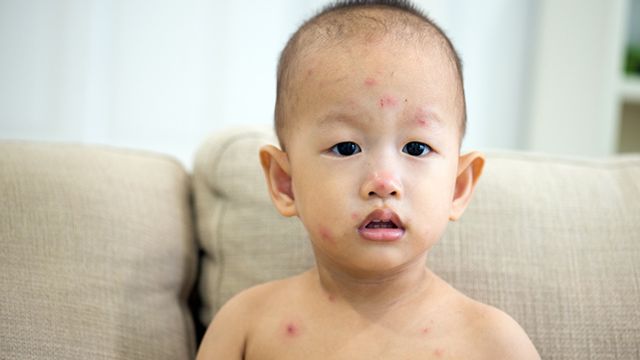 Chickenpox: Varicella Vaccine Is the Best Protection