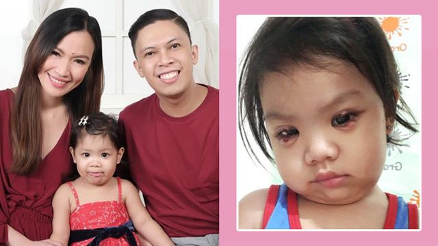 Stye Treatment: Toddler Gets Eye Surgery To Remove It