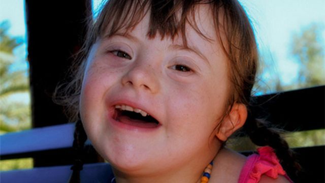 What you Need to Know about Down Syndrome