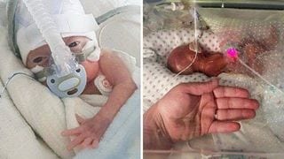 This One-Pound Preemie Baby Defied His Doctors and Survived
