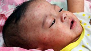 Measles Outbreak in Zamboanga: DOH Urges Parents to Vaccinate Kids