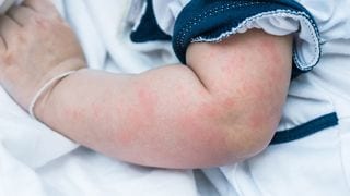 Managing Skin Asthma: 5 Products that Help