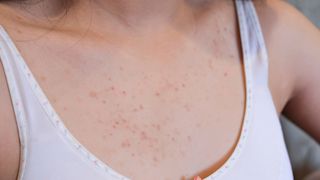 3 Dahilan Kung Bakit May Pimples Sa Dibdib At Hindi Sa Mukha