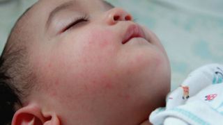 Kadalasang Bata Ang Nagkakaroon ng Dengue Rashes: Anong Ibig Sabihin Nito At Dapat Gawin