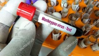 DOH Confirms First Case Of Monkeypox In PH, Tells The Public To Be Vigilant