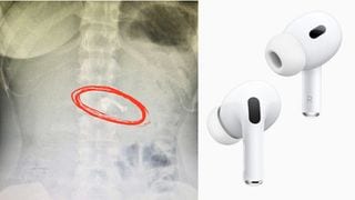 Young Filipina Swallows Airpods In Her Sleep, 'Scary, But I'm Lucky It Wasn't In My Lungs'