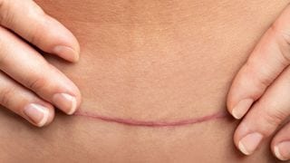 'C-Section is the Easy Way Out,' and Other Myths Debunked
